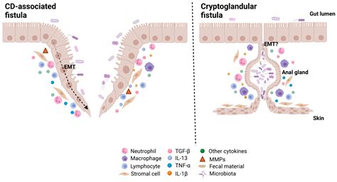 cryptoglandular fistula|More.